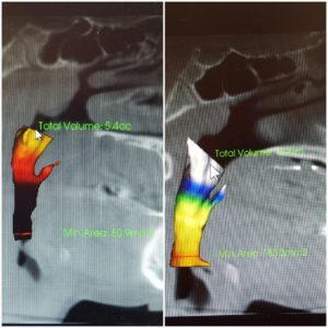 patient_1_ airway_scans