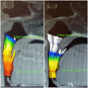 patient_case_2_CBCT