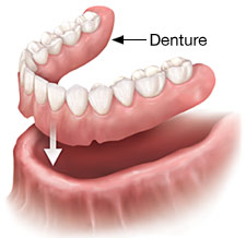 conventional-dentures