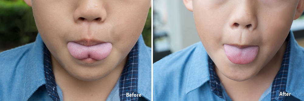 frenectomy-before-after