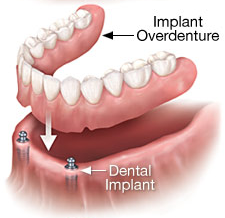 implant-overdenture