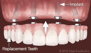 implants-replace-all-teeth