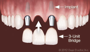 implants-replace-multiple-teeth