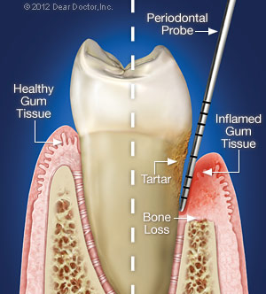 periodontal-disease