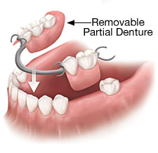 removable-partial-denture